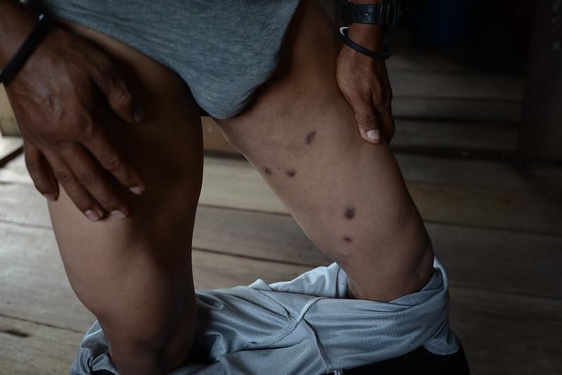 Un indígena miskito muestra las heridas de bala en su pierna en la comunidad de Esperanza, Río Wawa. Carlos Herrera | Divergentes.
