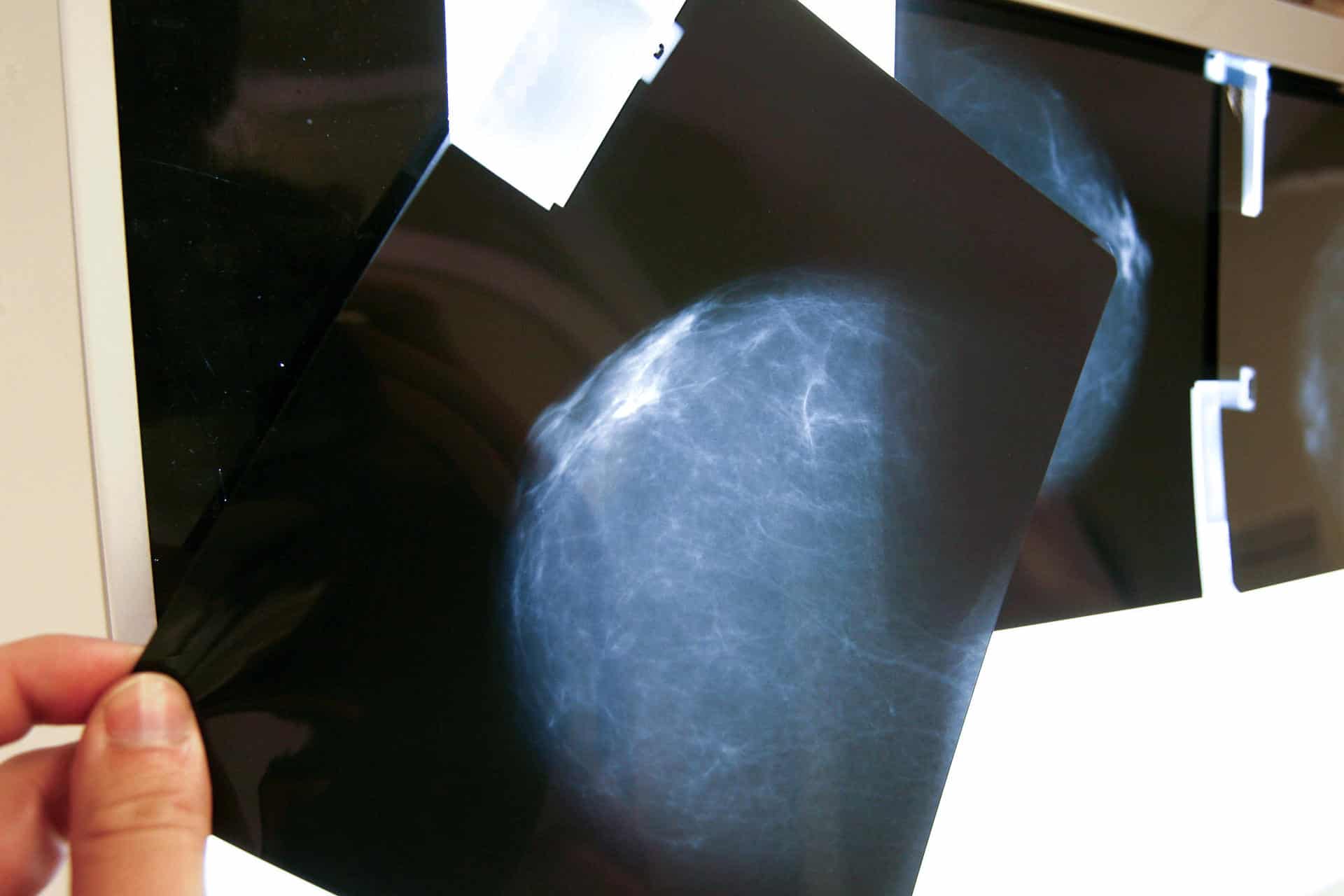 cáncer de mamá